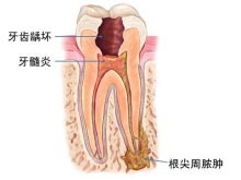 牙髓炎