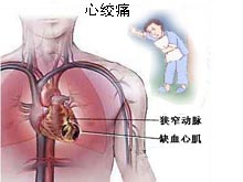 心绞痛