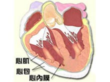 心内膜弹力纤维增生症