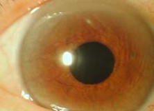 新生血管性青光眼