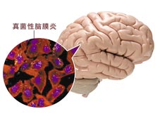 真菌性脑膜炎怎么治疗/治疗方法