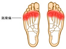 第一跖骨疼图片