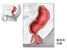 直肠脱垂