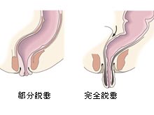 直肠粘膜脱垂