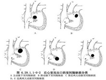 右心室双出口