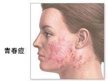青春痘
