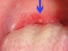 喉咙后咽壁有疱疹图片图片