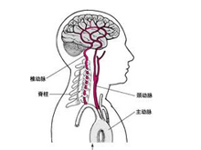 脑血管硬化