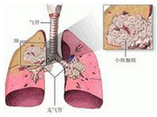 小細胞肺癌