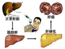 重度脂肪肝