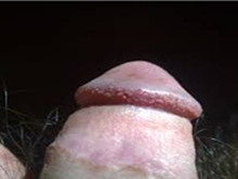 珍珠疹