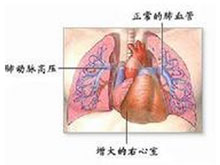 肺动脉高压