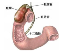 十二指肠球部溃疡