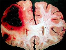脑动脉硬化是指由脑多发性梗死,软化,坏死,萎缩引起的慢性脑病,如神经