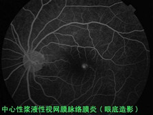 中心性浆液性脉络膜视网膜病变