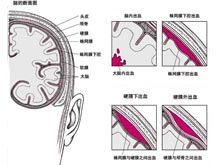 脑溢血