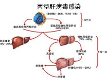 丙肝