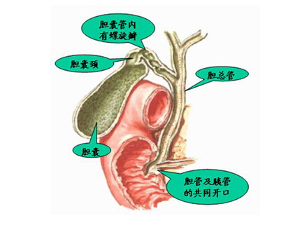 胆管囊状扩张症