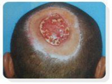 头皮、颅骨缺损