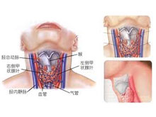 桥本甲状腺炎