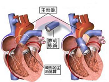 左心发育不良综合征