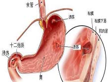 溃疡病急性穿孔