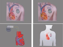 心脏起搏器植入术