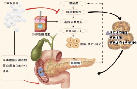 高胰岛素血症