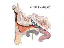 分泌性中耳炎