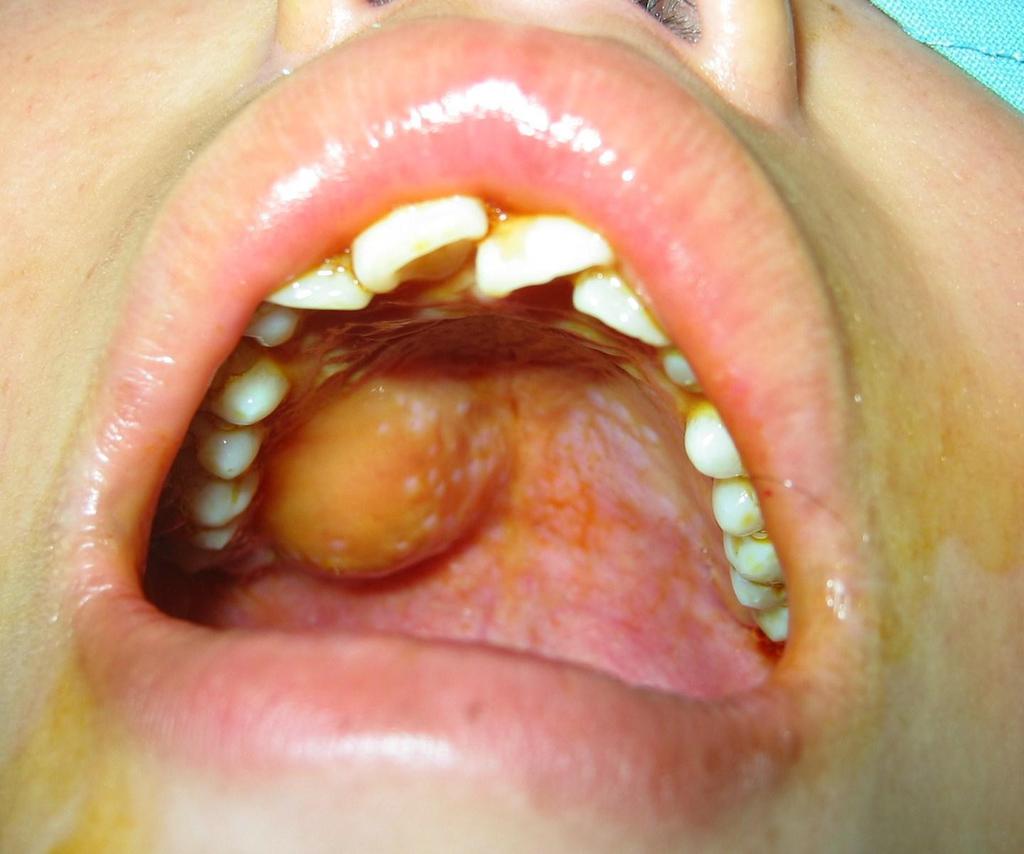口腔颌面部肿瘤早期症状表现