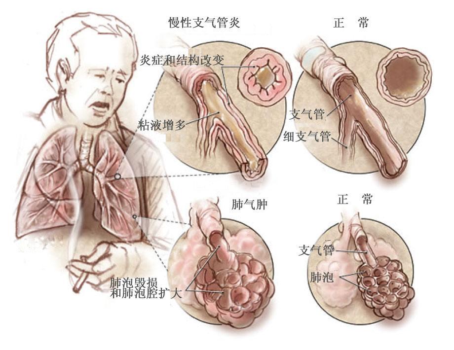 肺部疾病