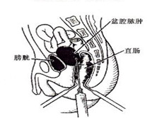 盆腔脓肿