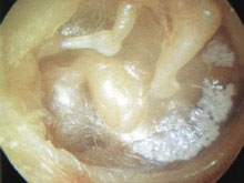 胆脂瘤型中耳炎