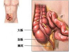 获得性免疫缺陷综合征伴发急性阑尾炎