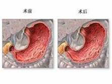 成人肥大性幽门狭窄