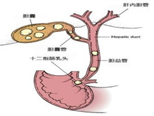 胆囊结石