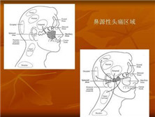 鼻源性头痛