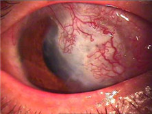 穿透性角膜移植术所致青光眼