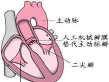 二尖瓣和主动脉瓣双病变