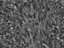 胆囊平滑肌肉瘤