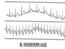 非阵发性窦性心动过速