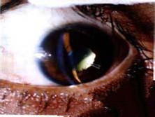 复发性多发性软骨炎伴发的葡萄膜炎