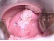 非特异性外阴炎