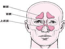 副鼻窦炎