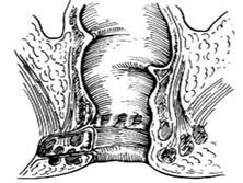 肛管内括约肌痉挛性收缩