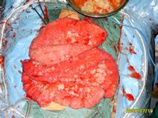 腹膜假黏液瘤