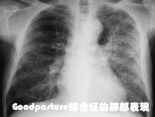 Goodpasture综合征