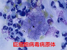 巨细胞病毒性肺炎