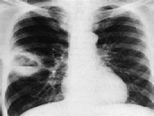 急性肺脓肿