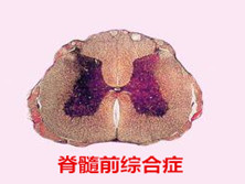 脊髓前综合征